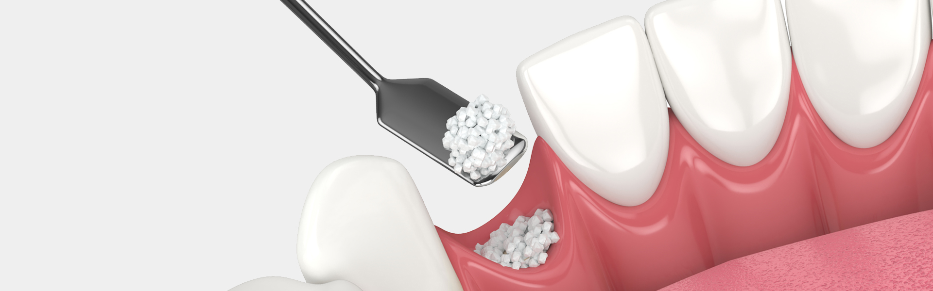 Bone Grafting