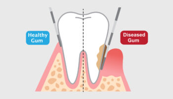 Gum Shaping: What It Is and Is It the Option for You