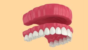 5 Things To Know Before Considering a Dental Bridge