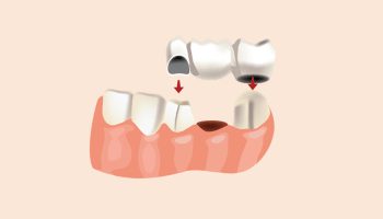 What Is the Best Type of Dental Crown to Get?